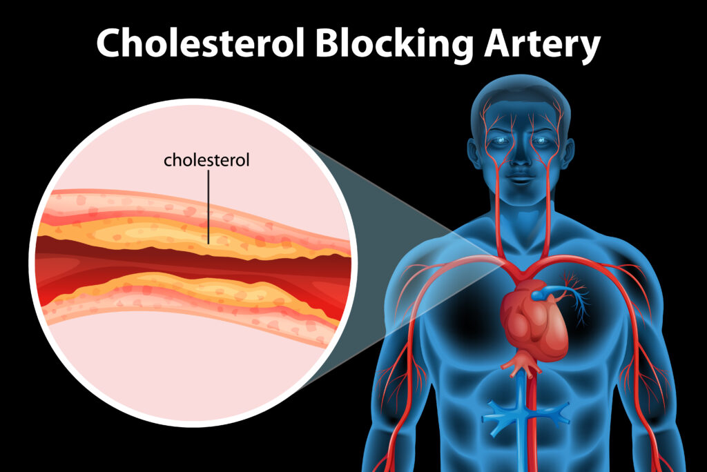 Cardiac Angioplasty