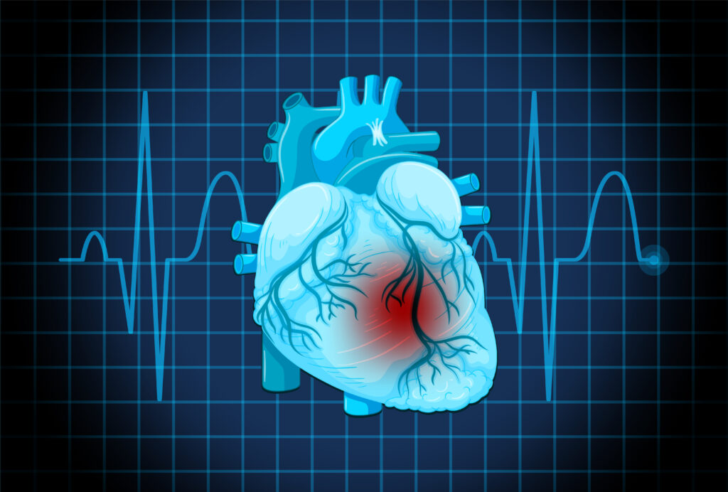Cardiac Angioplasty