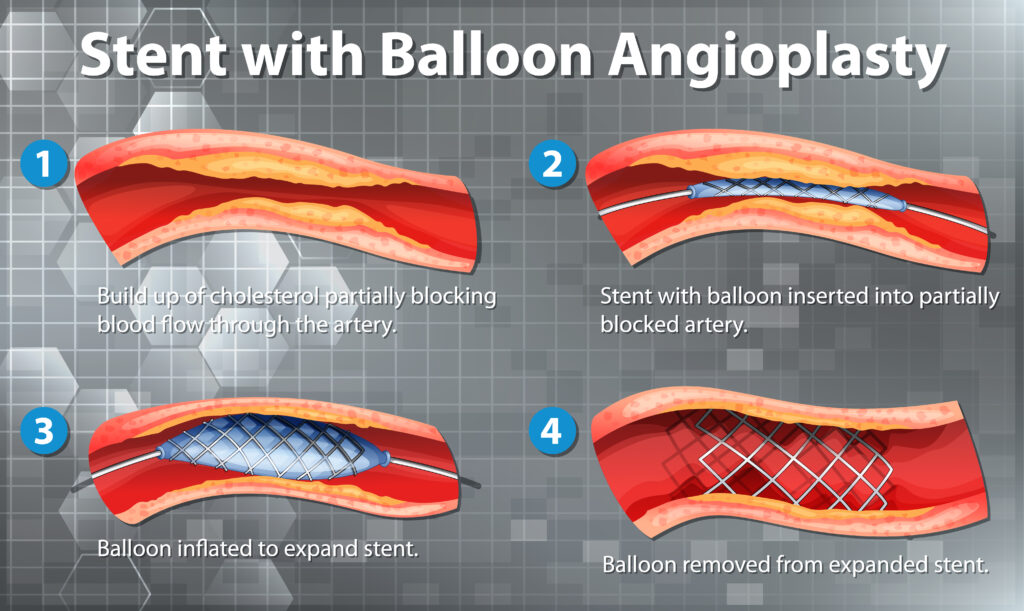 Rotablation Angioplasty 