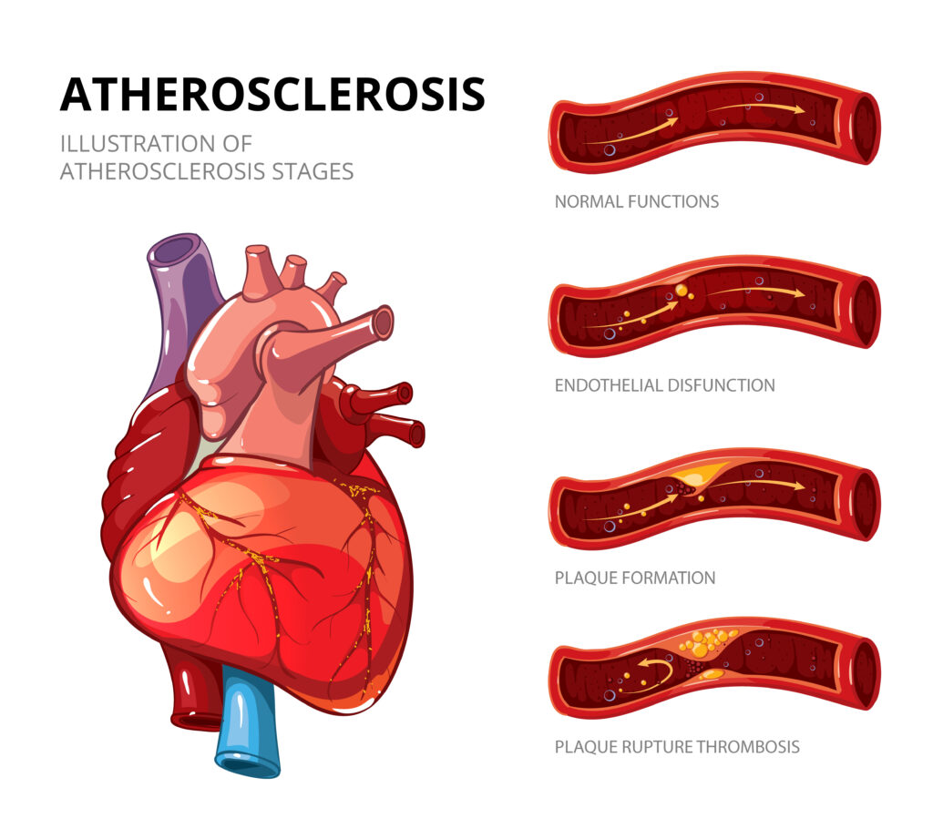 Rotablation Angioplasty