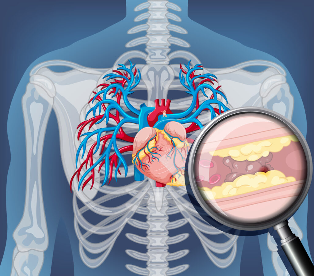 Coronary Artery Disease