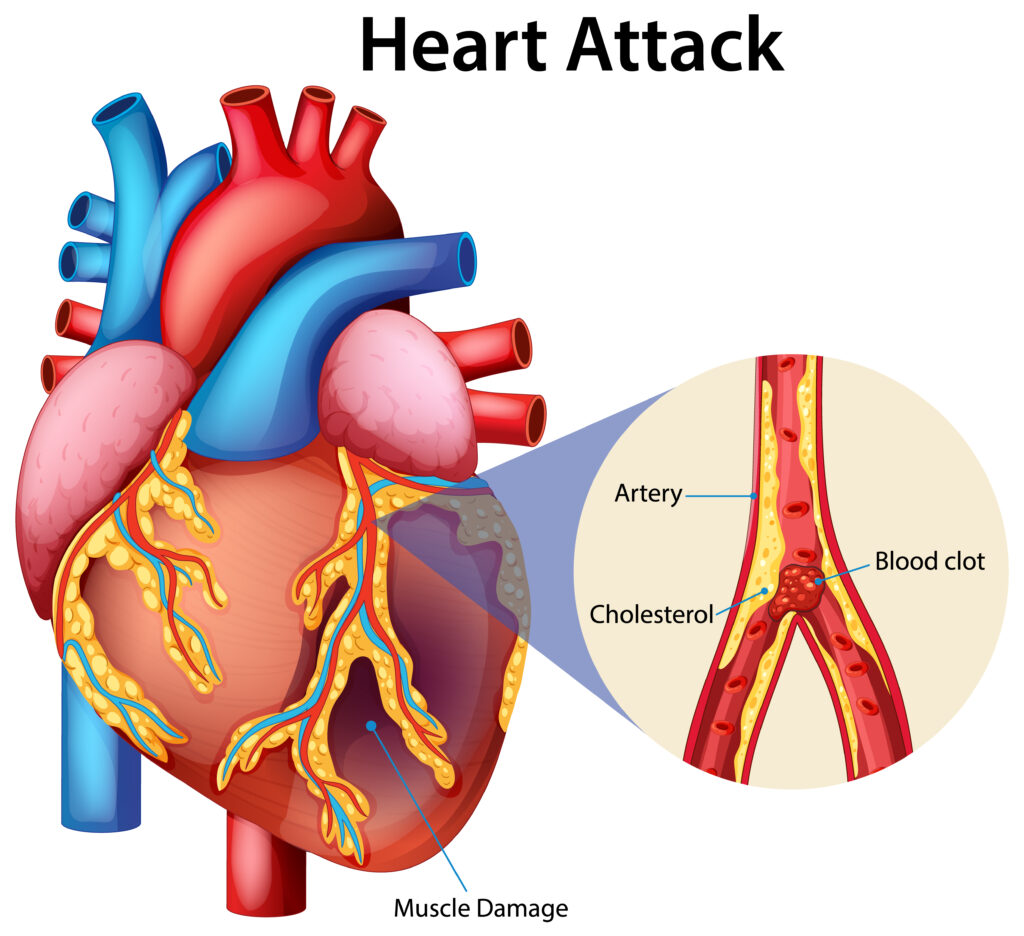 Heart Disease