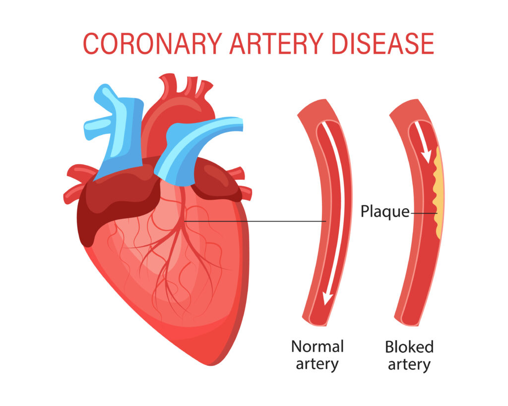 Coronary Artery