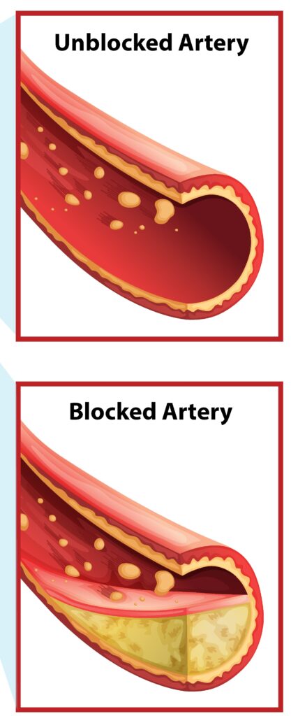 Coronary Artery